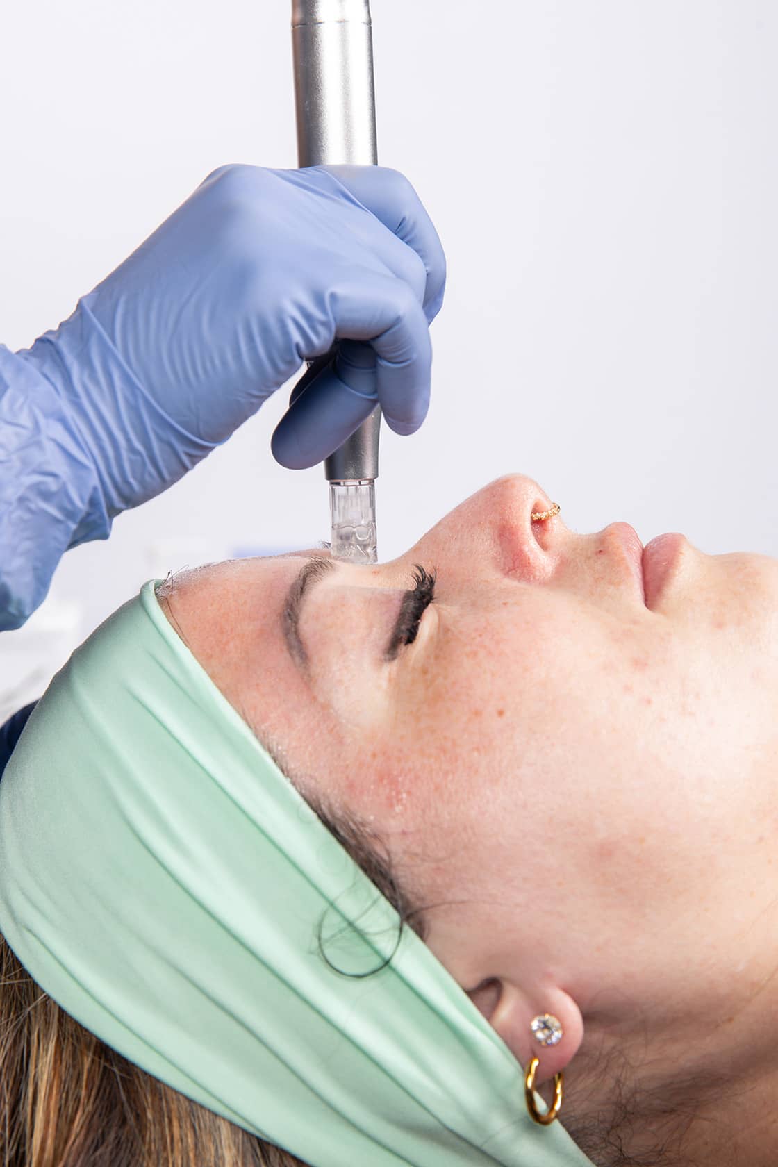 microneedling-06