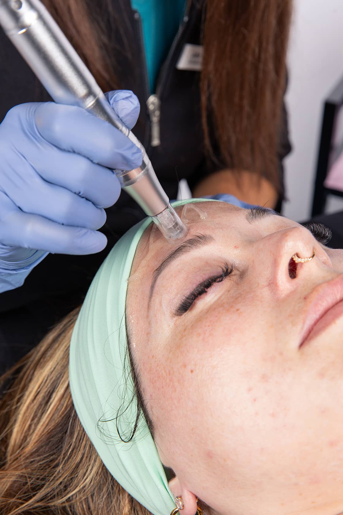 microneedling
